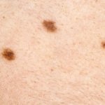 Dermatóloga advierte sobre el aumento del cáncer de piel