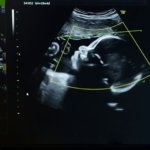 Los bebés están expuestos a “químicos eternos” incluso antes de nacer